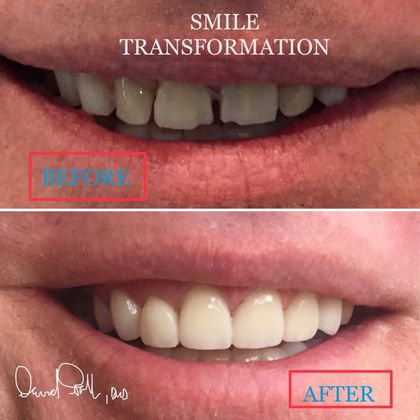 smile before veneers and smile after veneers