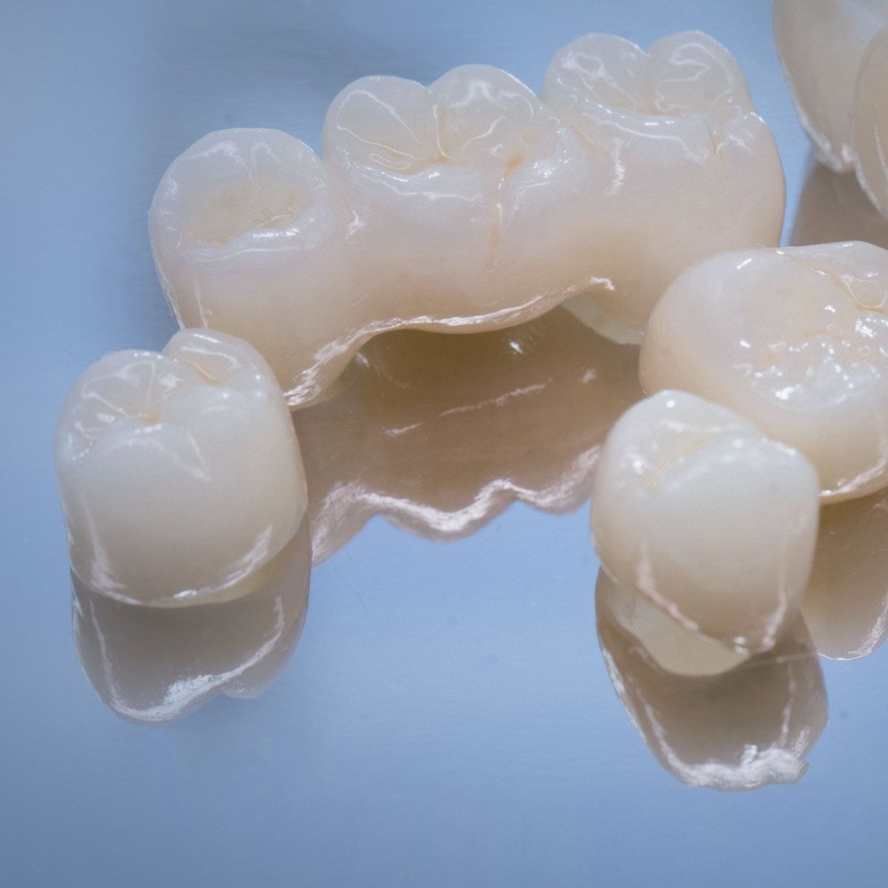 dental bridge