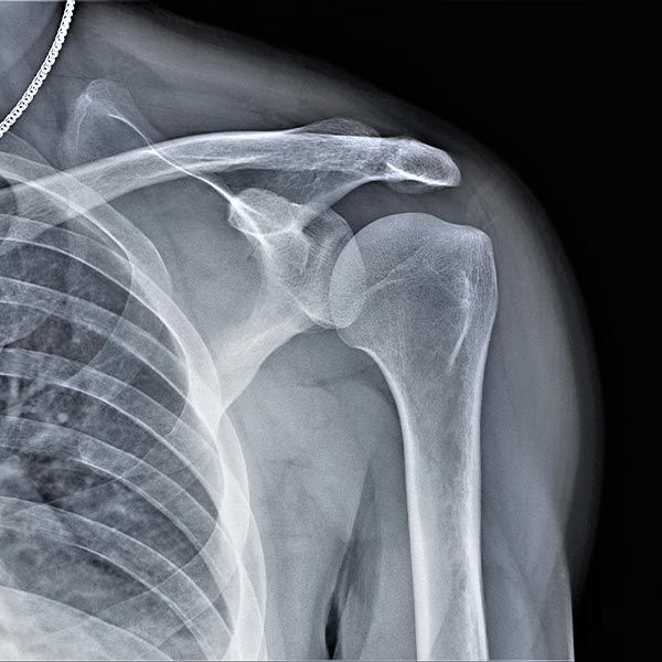 Shoulder X-ray