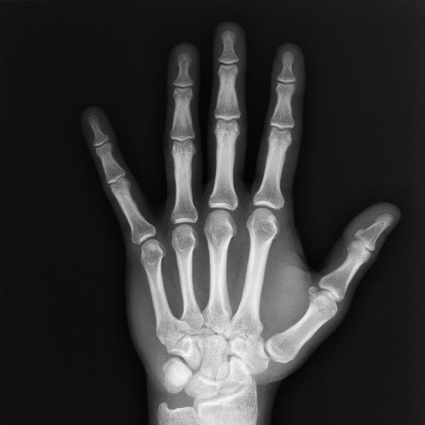 Hand x-ray