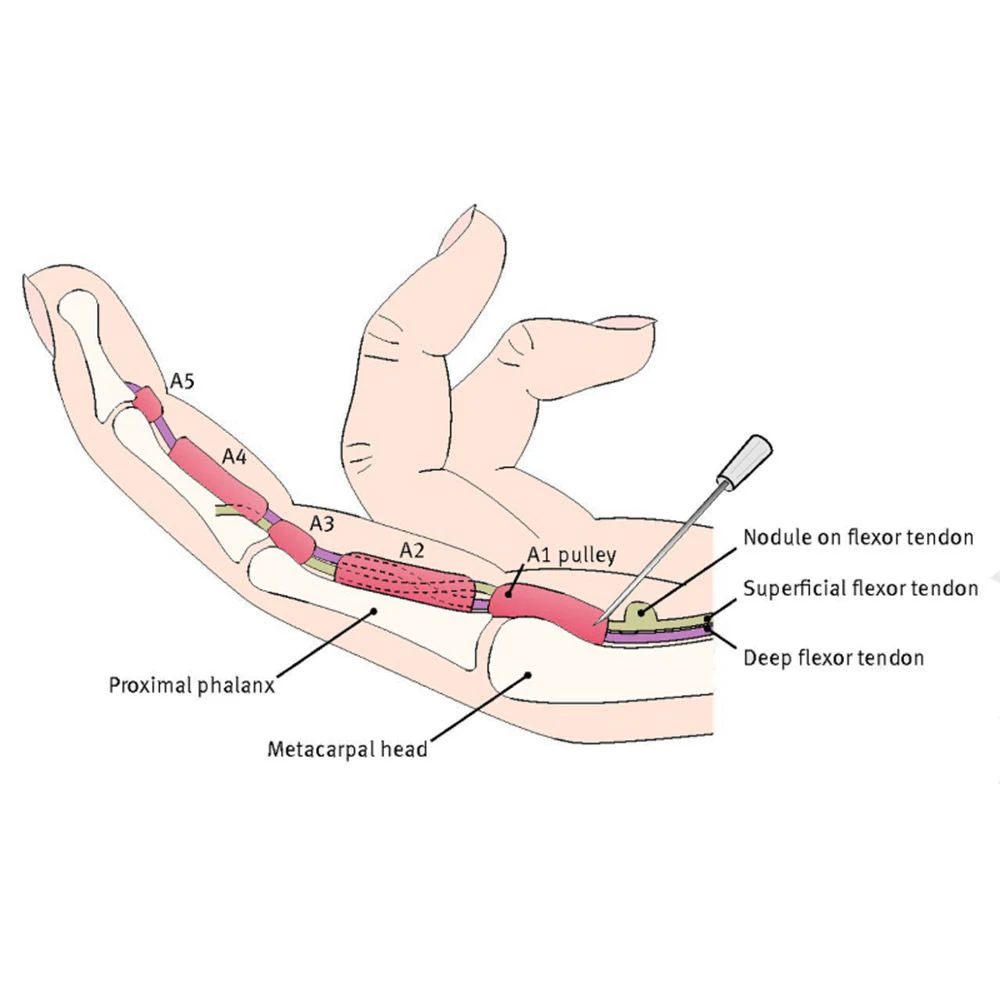 Trigger finger surgery illustration