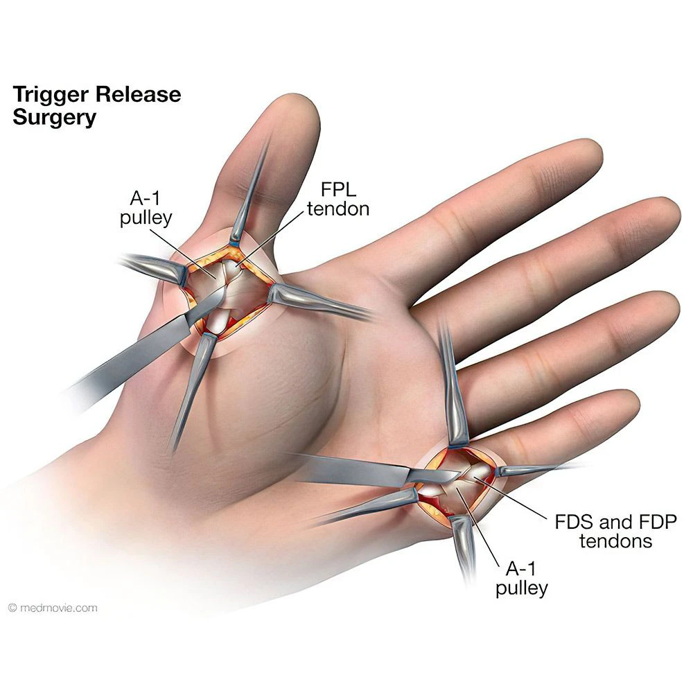 Trigger finger surgery illustration