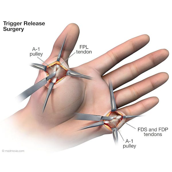 trigger finger surgery gél nyaki osteochondrozis kezelésére