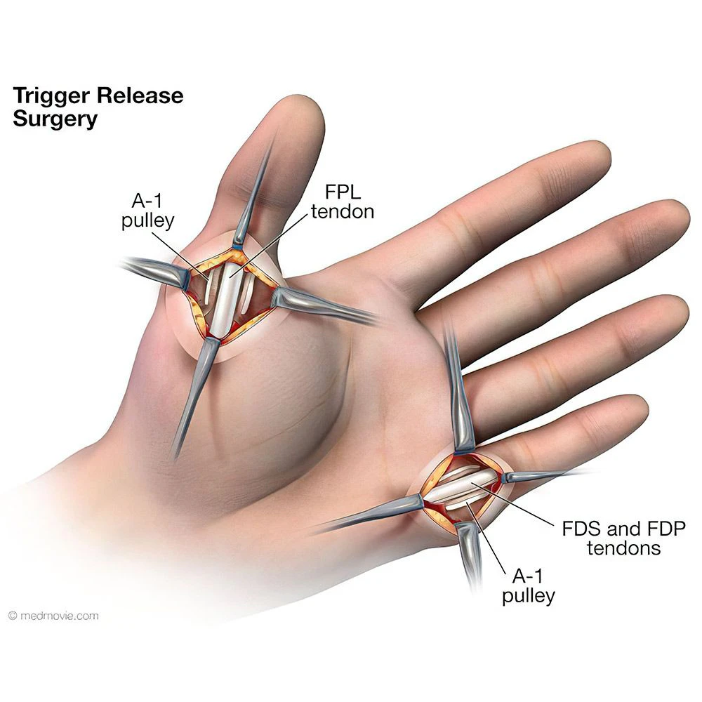 Trigger finger surgery illustration