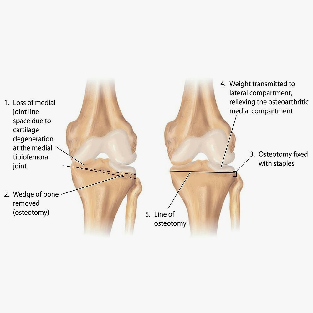 Diagram of knee affected by osteoarthritis