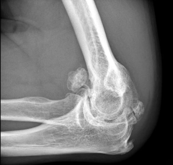 X-ray of elbow