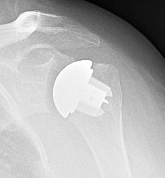 Anatomic Shoulder Replacement