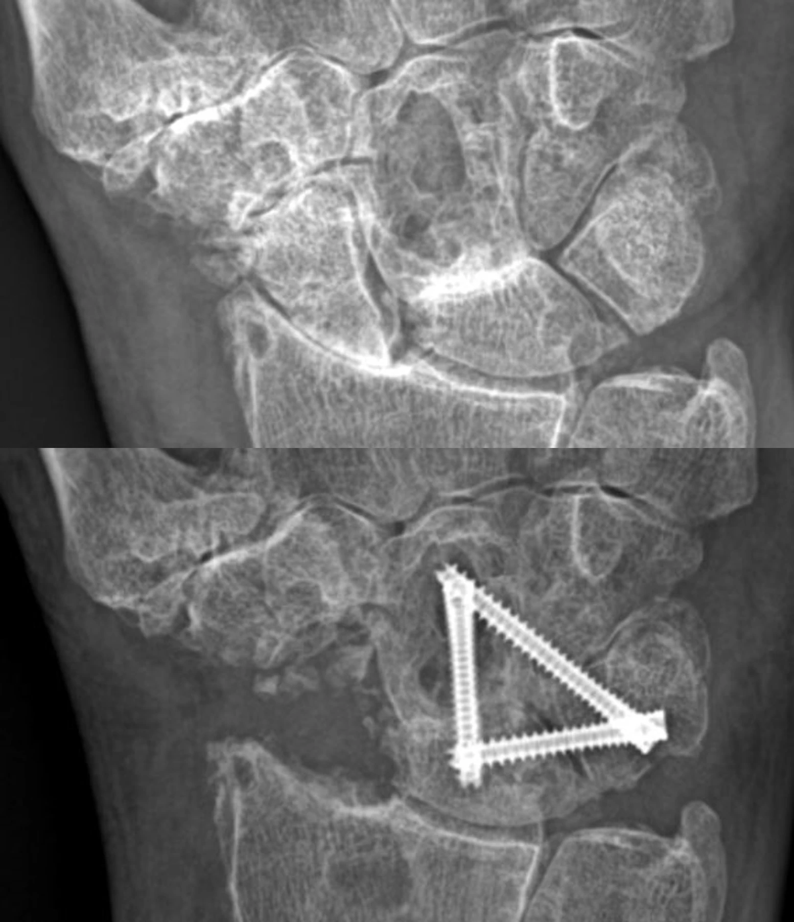 Diagram of knee affected by osteoarthritis 