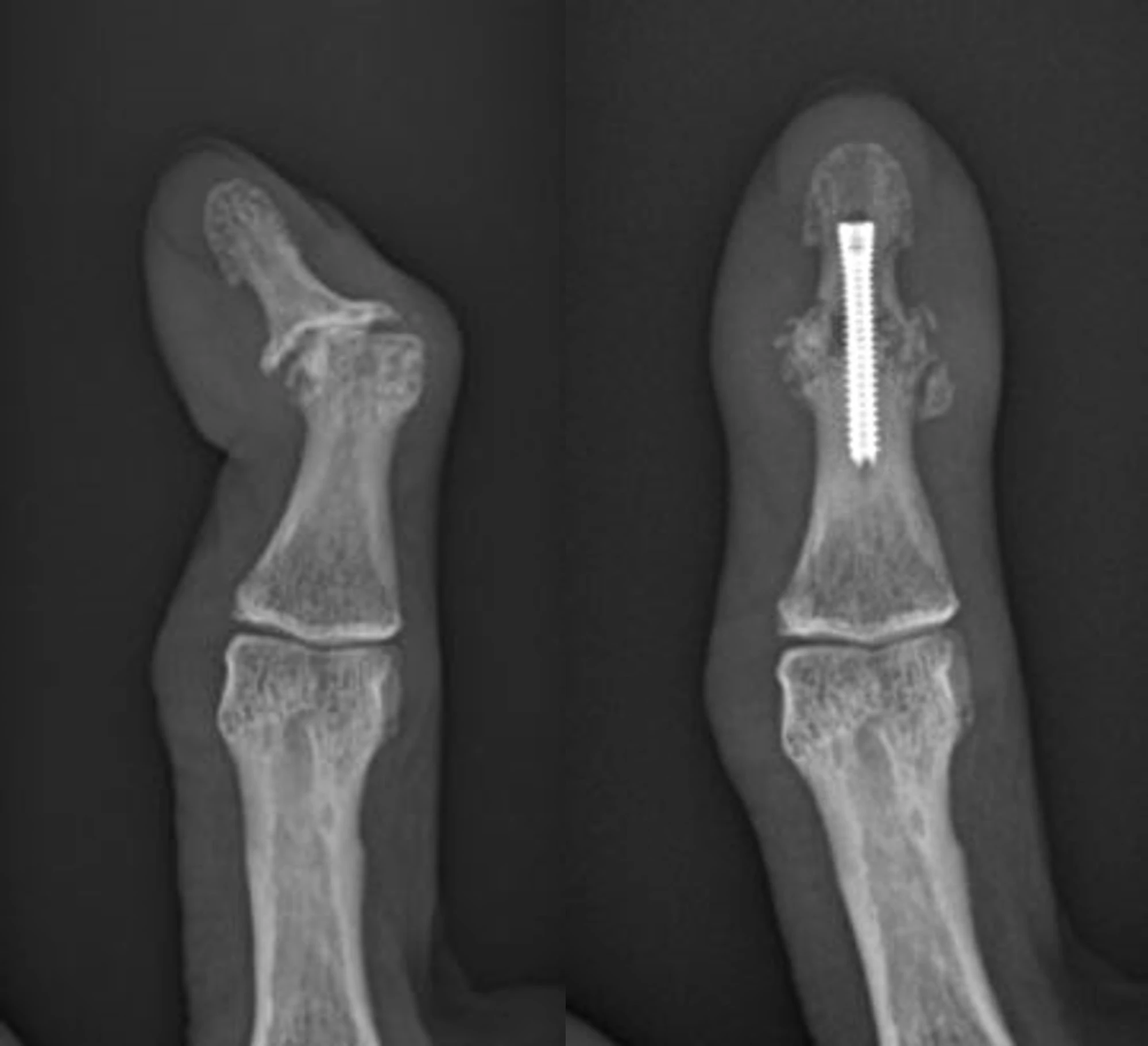 X-ray of DIP joint after arthrodesis fusion surgery