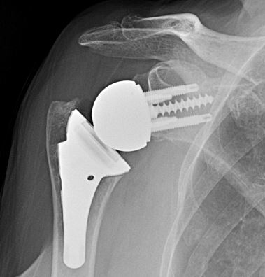 Reverse Shoulder Replacement