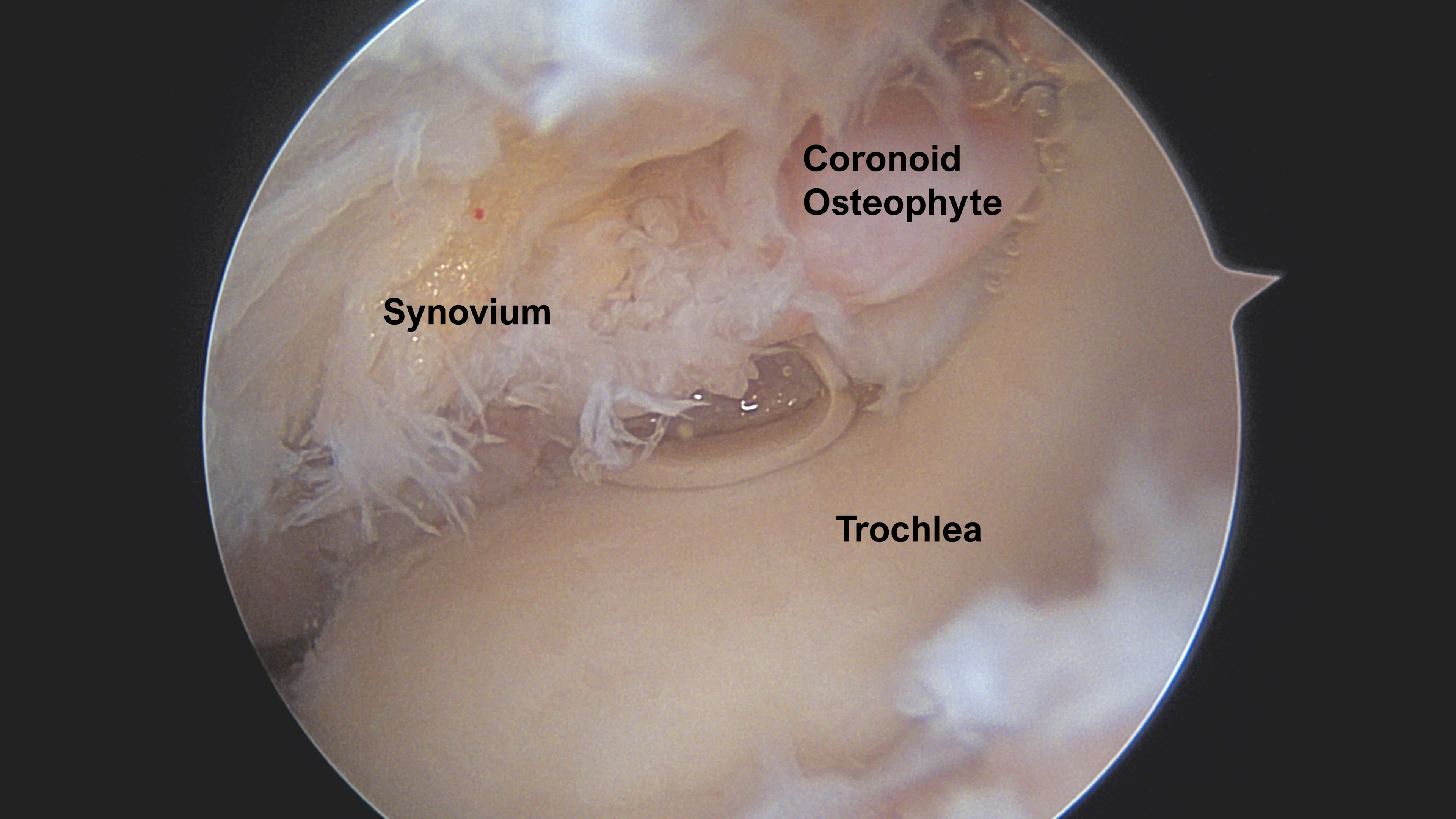 Elbow arthroscopic view of anterior joint with synovitis and arthritis