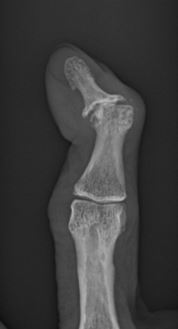 X-ray of finger bent by arthritis