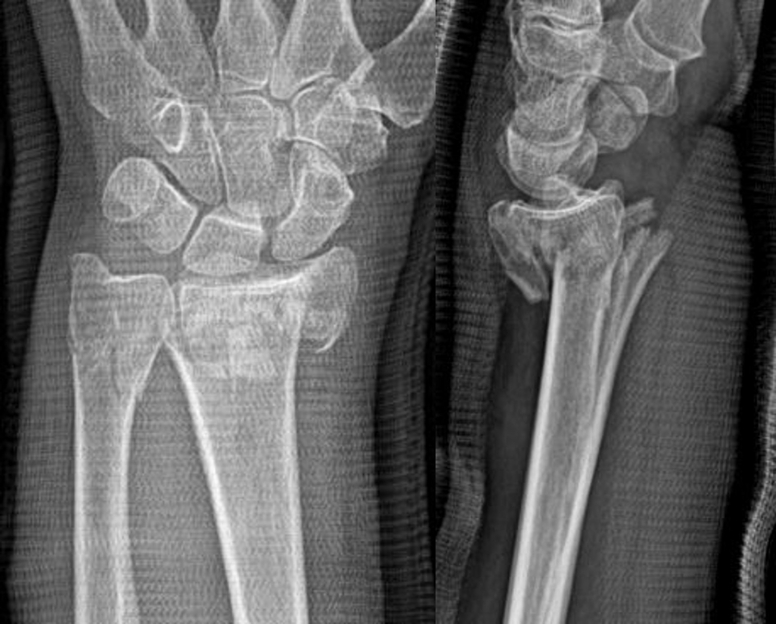 Wrapping a Wrist Fracture