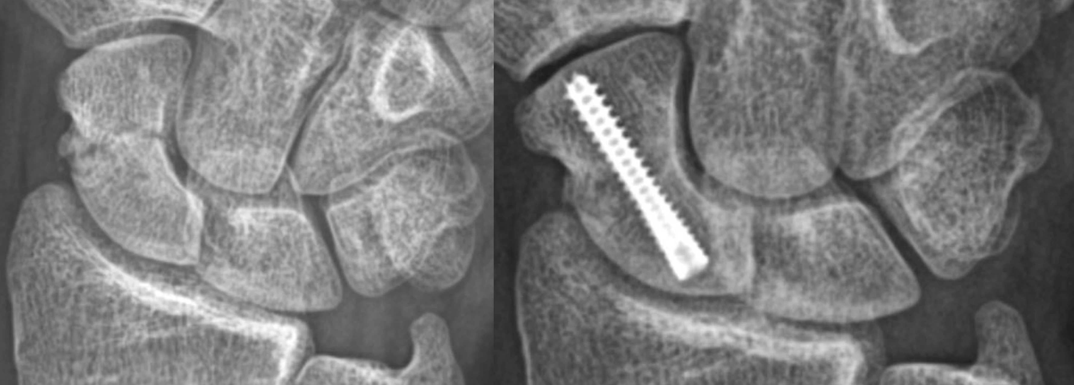 X-ray of hand fracture