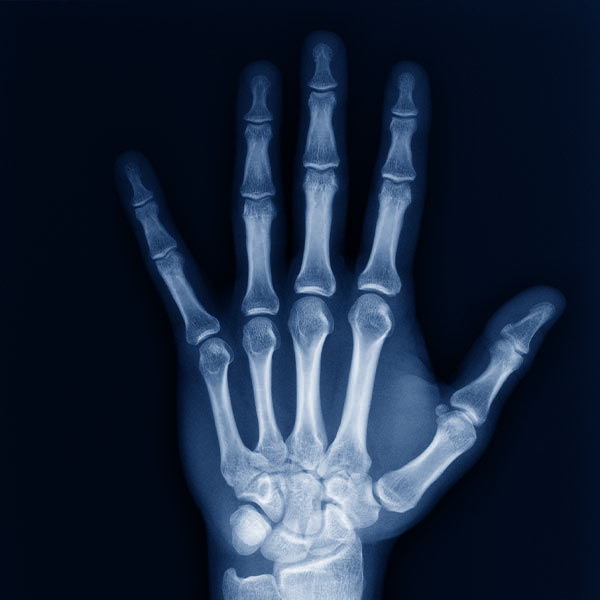 x-ray of a hand
