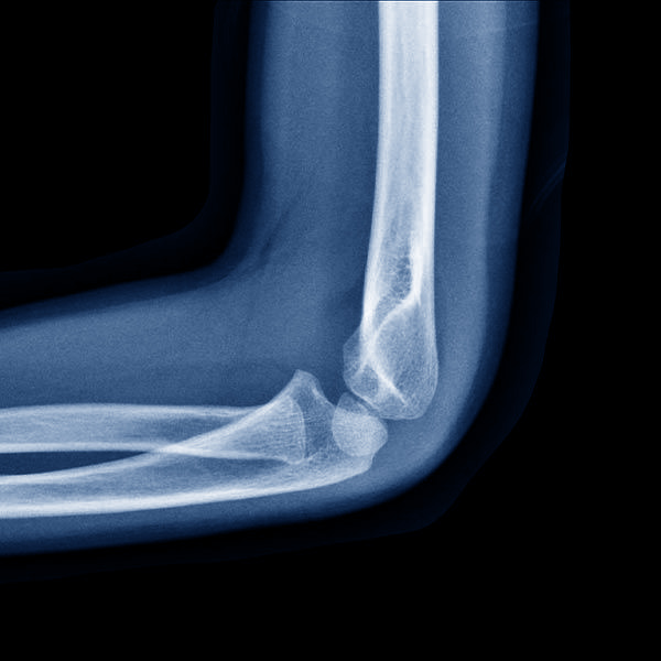 x-ray of an elbow