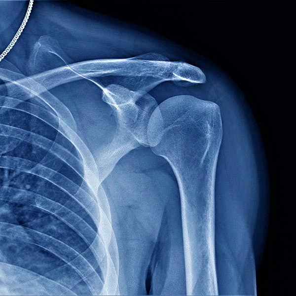 x-ray of a shoulder