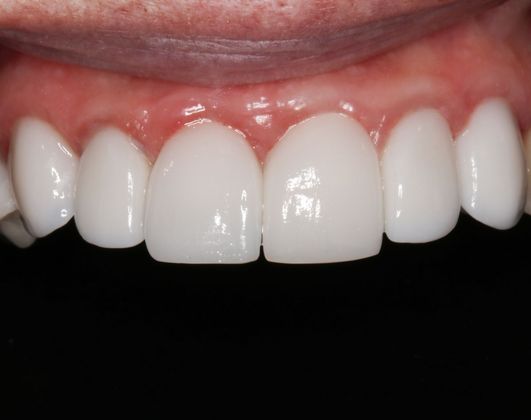 Porcelain Veneers