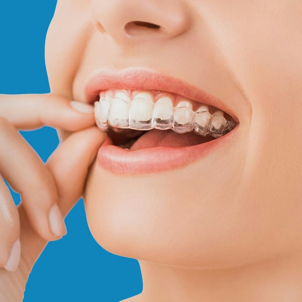 Woman placing clear aligner on teeth
