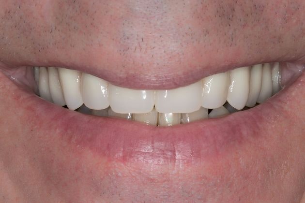 Case 2 after procedure