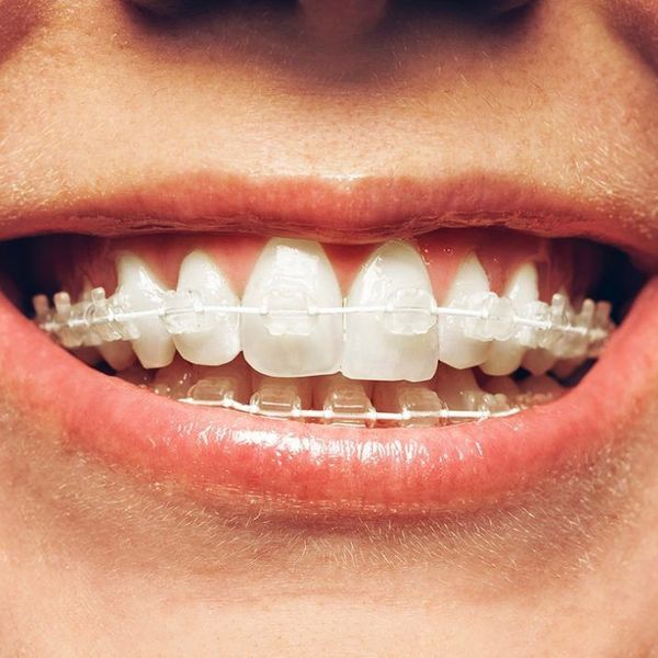 ceramic braces