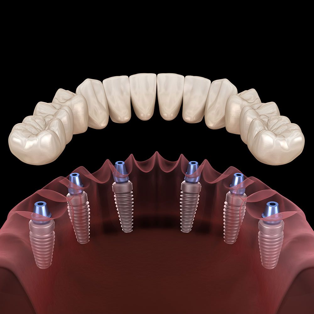 Dental Implants Columbus, MS - Implant Dentistry - Golden Triangle ...