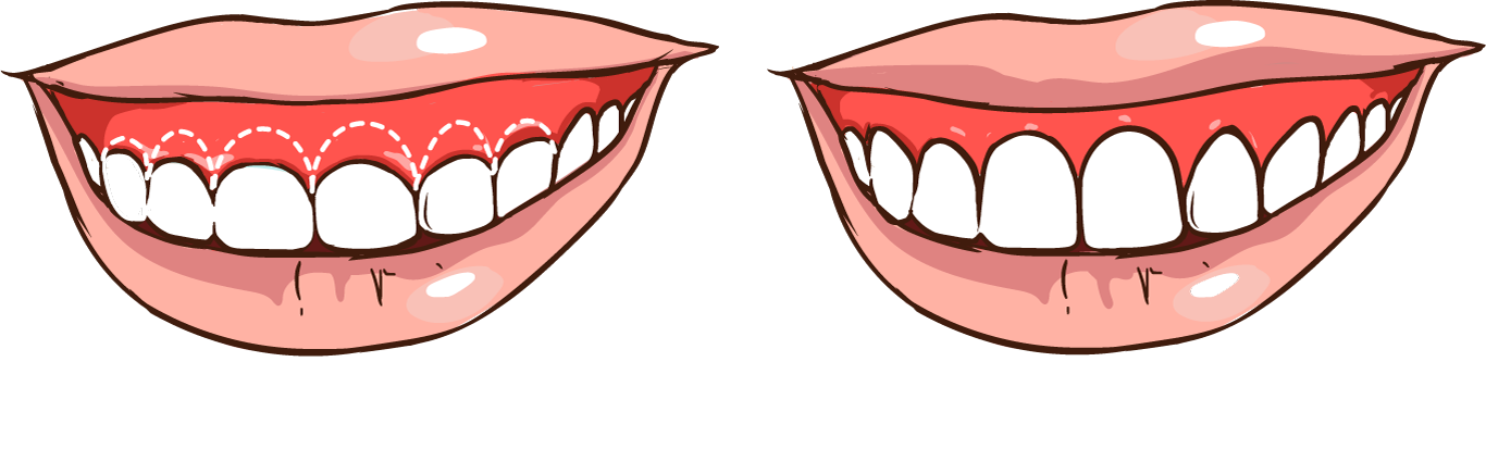 Before and after gum contouring