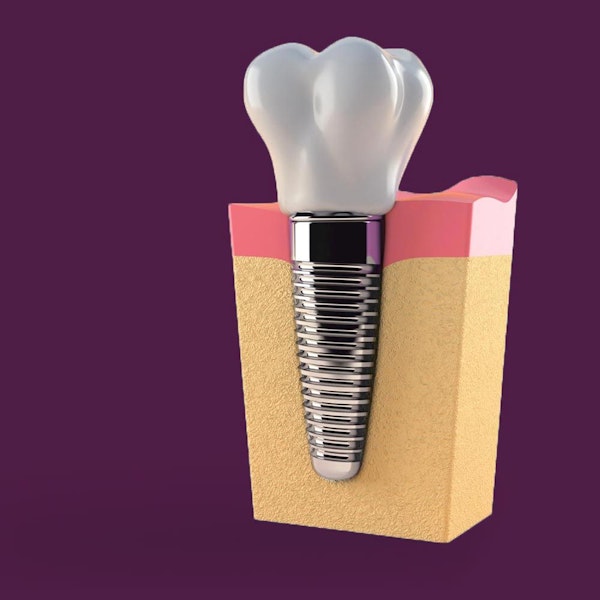 dental implant attached to placement tool