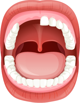 illustration of a mouth missing multiple teeth