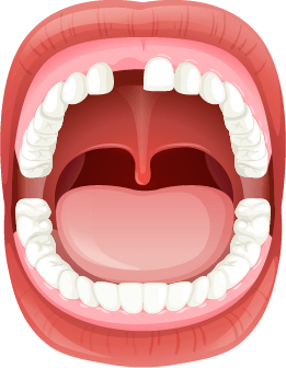illustration of a mouth missing a single front tooth