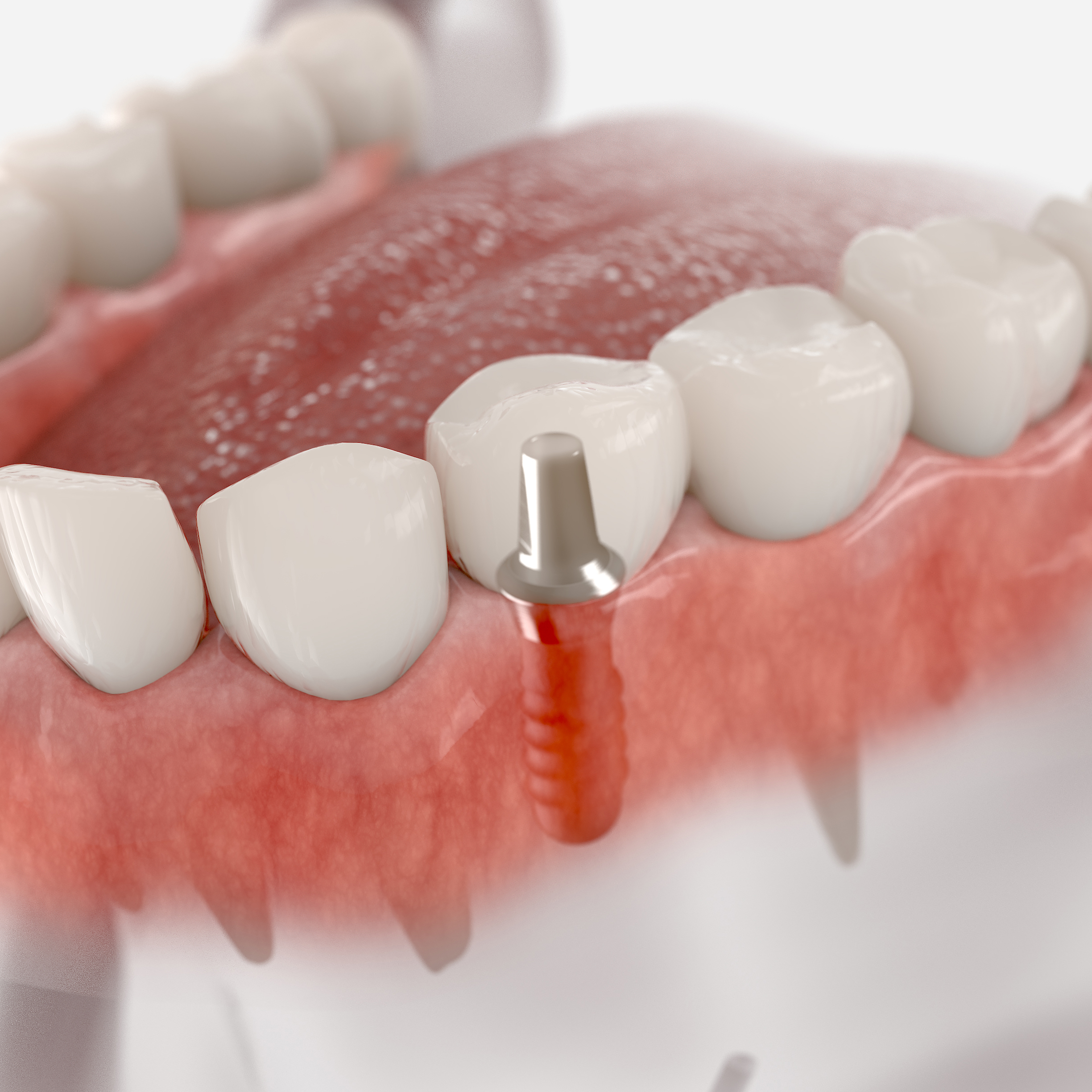 dental implants