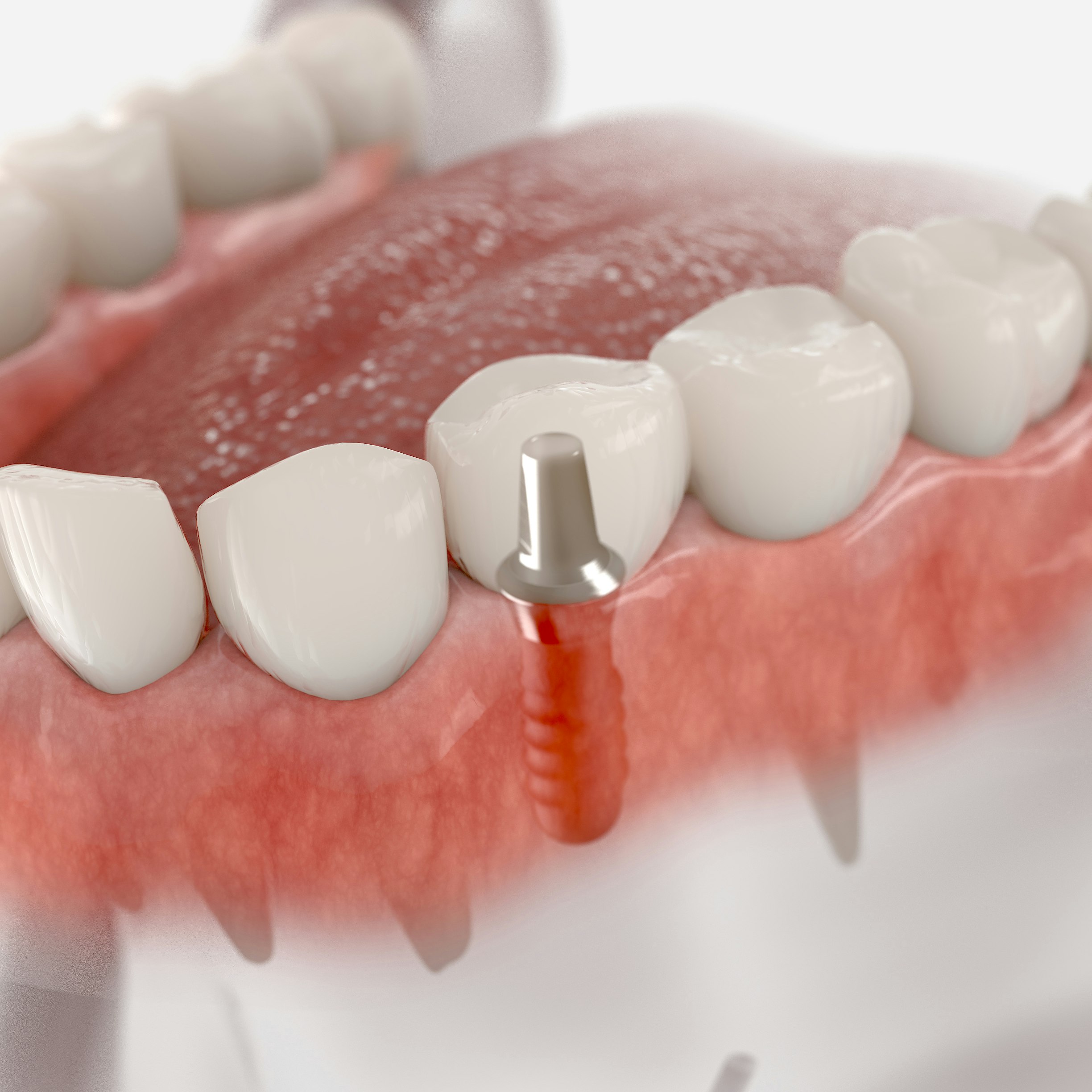 dental implants