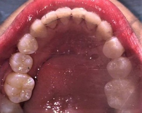 Dr. Ashley Ramsey's patient after FASTBRACES