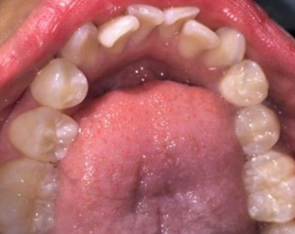 Dr. Ashley Ramsey's patient before FASTBRACES