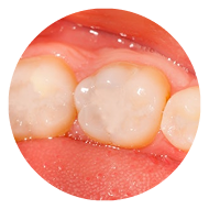 tooth with a filling