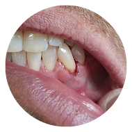 inflamed gum tissue