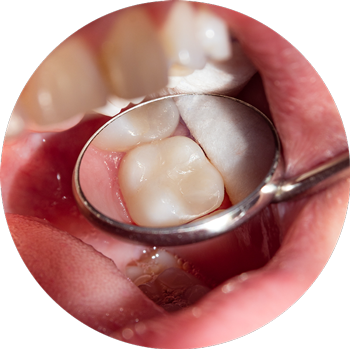 Fillings