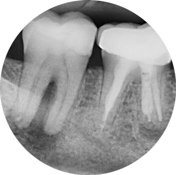 Root canal Therapy