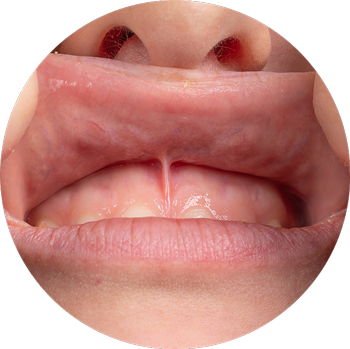 Frenectomy