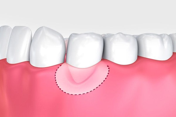 Illustration of gum graft
