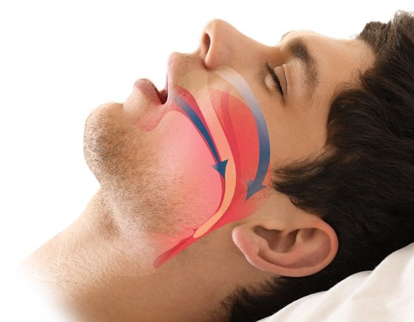 obstructive sleep apnea