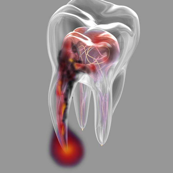 Illustration of tooth with bacteria