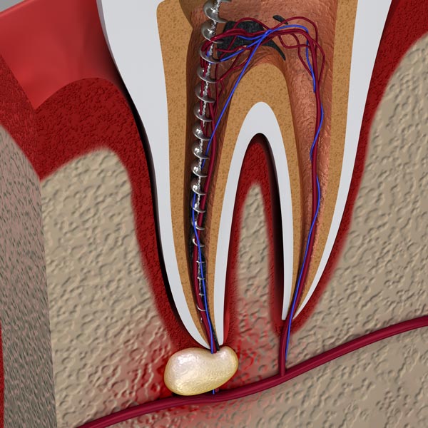 Illustration of root canal procedure