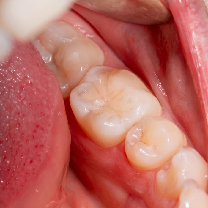 Tooth with Dental Fillings