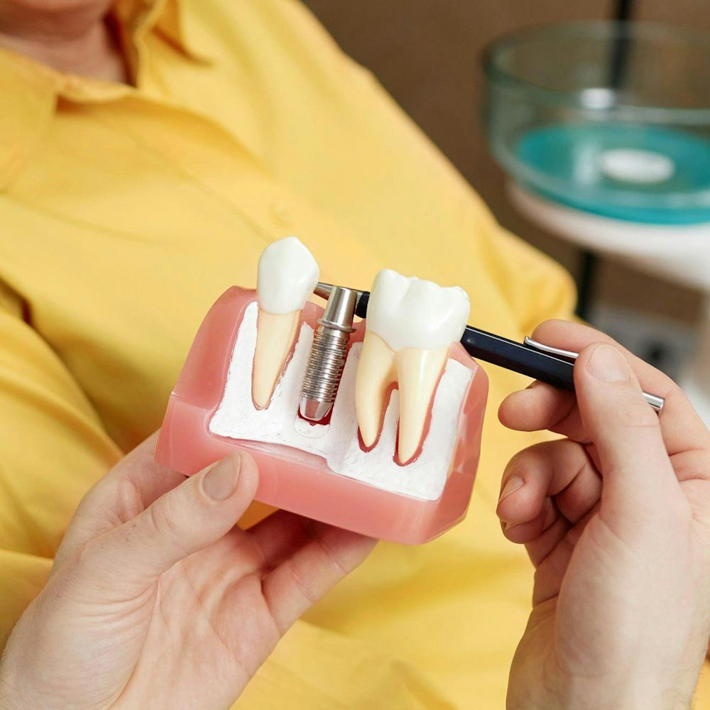 Dental Implants