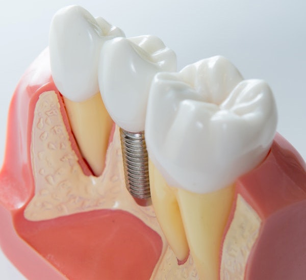dental implant in gum