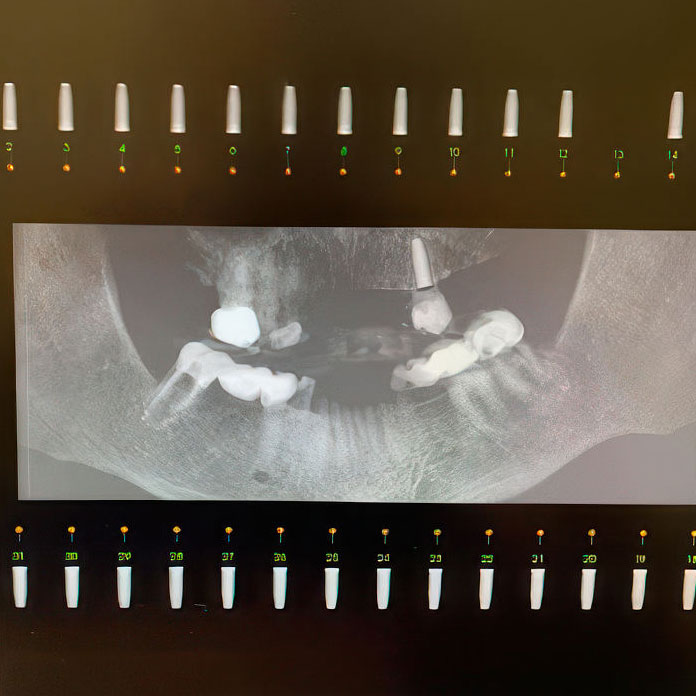 Digital dental x-ray