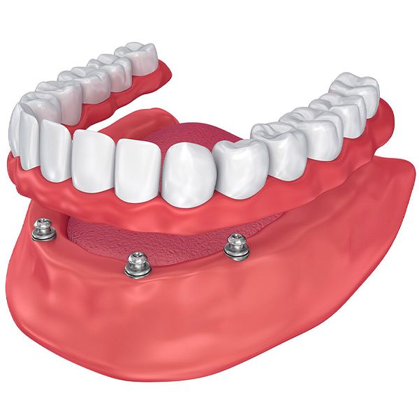 Implant-supported denture