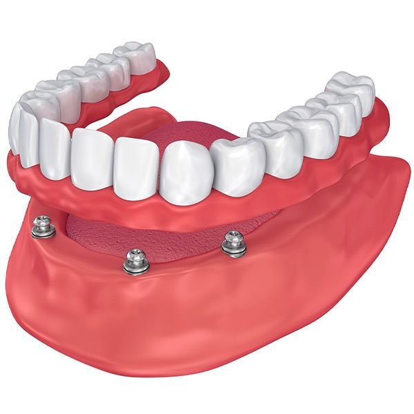 Implant-supported denture