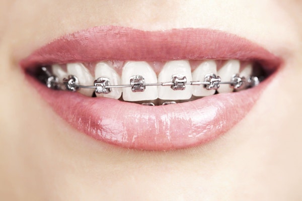 Traditional metal braces
